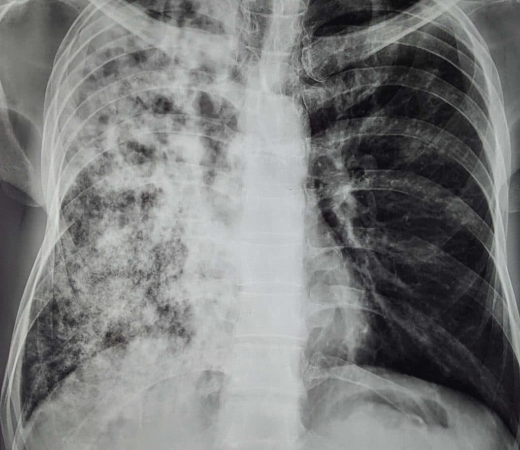 Lungs X Ray Legionnaires