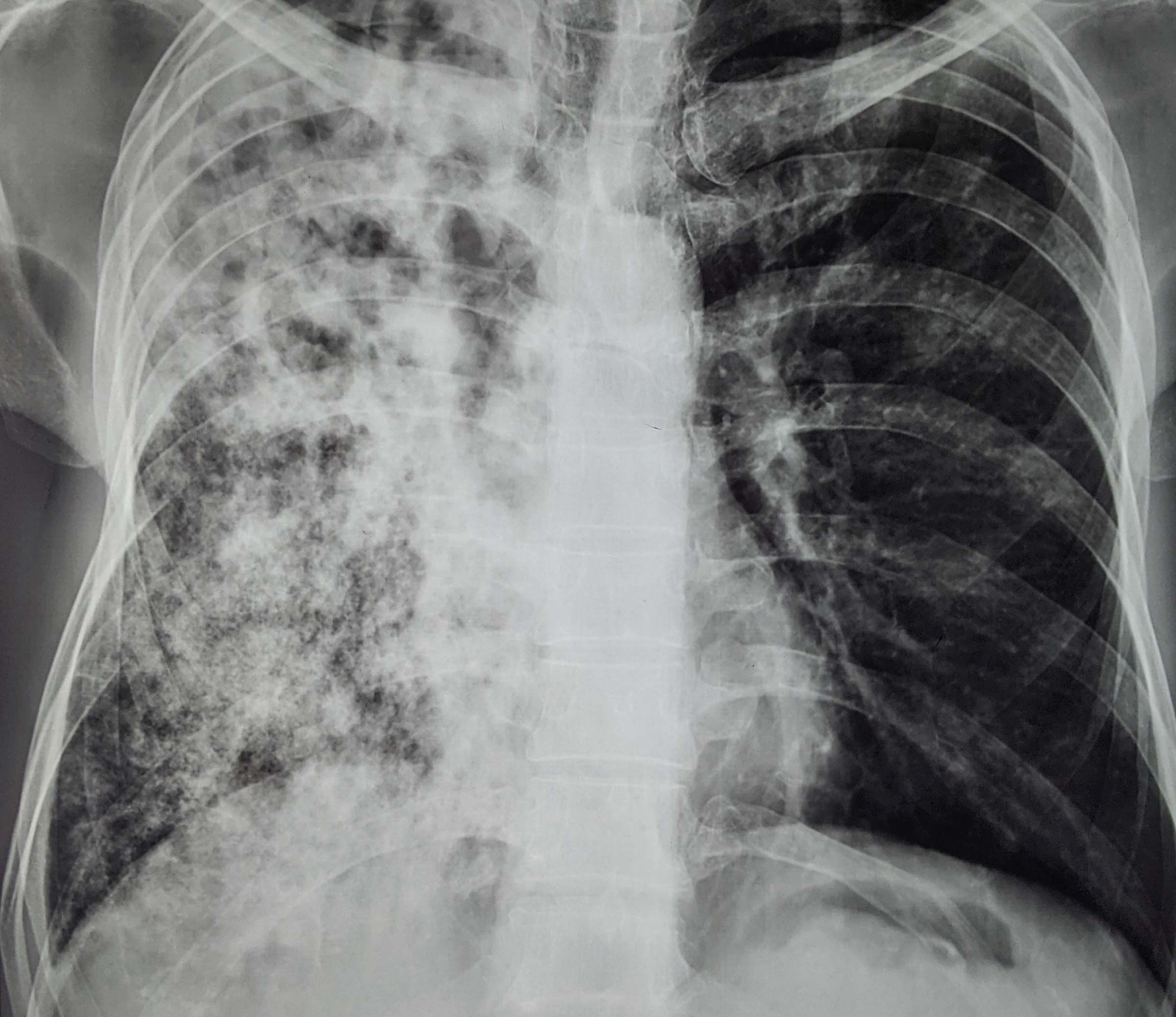 Lungs X Ray Legionnaires